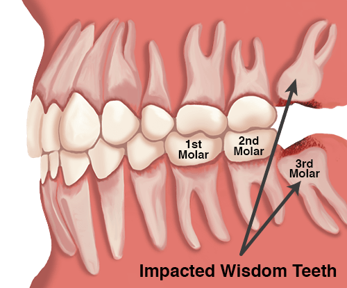 IMPACTED WISDOM TOOTH